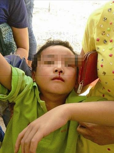昨天上午,樂清市北白象鎮(zhèn)第九小學,一名學生突然流鼻血被送往醫(yī)院。 家長供圖